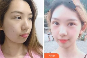 十堰阿芙羅醫(yī)療整形美容門診部林平珍整形價(jià)格表附埋線提升案例展示