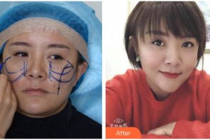 十堰東慧醫(yī)療美容門診部曾祥蘭整形價(jià)格表附埋線提升案例展示