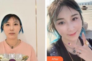 十堰東慧醫(yī)療美容門診部余建軍整形價(jià)格表附埋線提升案例展示