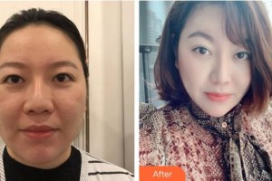 十堰梵媞醫(yī)學(xué)美容門診部張琴真整形價(jià)格表附埋線提升案例展示