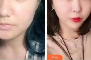 十堰陽光整形醫(yī)院楊峰整形價(jià)格表附埋線提升案例展示
