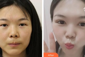 十堰愛爾眼科醫(yī)院黃濤整形價(jià)格表附眼部綜合案例展示