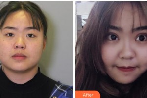 十堰愛爾眼科醫(yī)院張守奇整形價(jià)格表附眼部綜合案例展示