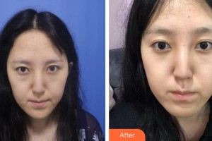 十堰愛爾眼科醫(yī)院楊永清整形價(jià)格表附激光去眼袋案例展示