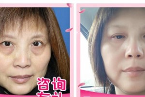 十堰愛爾眼科醫(yī)院鄭瑞整形價(jià)格表附激光去眼袋案例展示