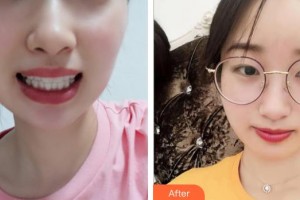 十堰東風(fēng)口腔醫(yī)院陳麗榮整形價格表附牙齒隱形矯正案例展示