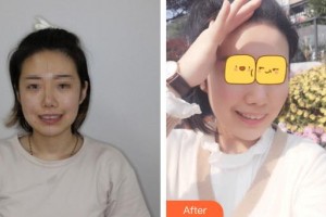 十堰東風(fēng)口腔醫(yī)院龍明生整形價格表附牙齒隱形矯正案例展示