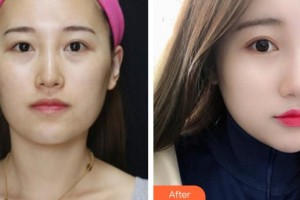 襄陽(yáng)華美醫(yī)療美容門診部羅定安整形價(jià)格表附去痘印痘坑案例展示