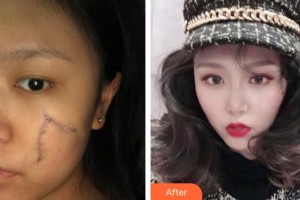 襄陽市中心醫(yī)院整形美容科劉丹丹整形價格表附光子嫩膚案例展示
