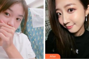襄陽(yáng)德?tīng)柮揽臀髯俞t(yī)療整形美容門診部黃亮誼整形價(jià)格表附硅膠隆鼻案例展示