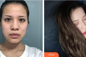 襄陽(yáng)海峽醫(yī)療美容門診部劉劍整形價(jià)格表附鼻部綜合案例展示