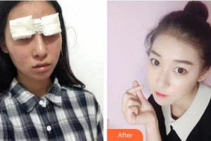 襄陽(yáng)愛(ài)爾眼科醫(yī)院趙建敏整形價(jià)格表附切開(kāi)雙眼皮案例展示
