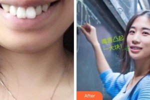 襄陽(yáng)時(shí)代口腔醫(yī)院呂吳紀(jì)整形價(jià)格表附金屬托槽矯正案例展示
