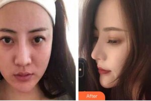 九江愛爾中山眼科醫(yī)院李紅鋒整形價(jià)格表附鼻修復(fù)案例展示
