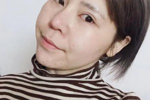 新余嘉和醫(yī)療美容門診部崔亞鵬整形價格表附眼部手術案例展示