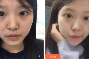撫州美萊爾醫(yī)療美容門診部斯樓斌整形價(jià)格表附切開(kāi)雙眼皮案例展示