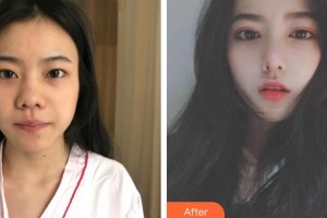 撫州韓尚醫(yī)療美容門診部戴凌欽整形價(jià)格表附切開(kāi)雙眼皮案例展示