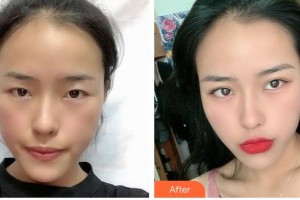 撫州江醫(yī)生醫(yī)療美容門診部周璇整形價(jià)格表附切開(kāi)雙眼皮案例展示