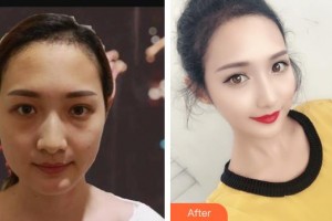 上饒韓美整形美容醫(yī)院黃陽(yáng)整形價(jià)格表附超聲提拉案例展示