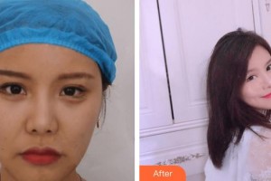 上饒榮美醫(yī)療美容門診部周麗艷整形價格表附埋線提升案例展示