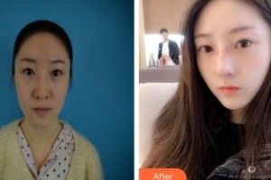 烏魯木齊美容學(xué)會整形美容門診部扈惠芝整形價(jià)格表附鼻部綜合案例展示