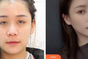烏魯木齊美容學(xué)會整形美容門診部許黎整形價(jià)格表附鼻部綜合案例展示