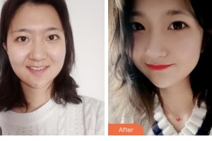 昆山百達(dá)麗醫(yī)療美容門診部楊宇光整形價格表附光子嫩膚案例展示