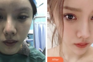 宿遷市人民醫(yī)院燒傷整形美容科王雪山整形價(jià)格表附切開雙眼皮案例展示
