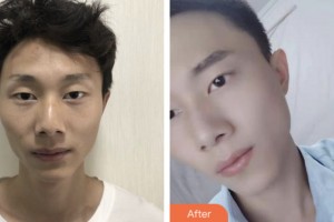 淮安仁愛醫(yī)院醫(yī)療美容科潘可松整形價格表附埋線雙眼皮案例展示