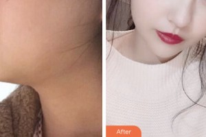 淮安仁愛醫(yī)院醫(yī)療美容科趙賢民整形價格表附埋線提升案例展示