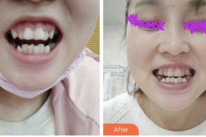 荊門(mén)小白兔口腔醫(yī)院趙小康整形價(jià)格表附超聲波潔牙案例展示