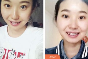荊門(mén)小白兔口腔醫(yī)院杜成整形價(jià)格表附自鎖托槽矯正案例展示