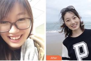 荊門(mén)小白兔口腔醫(yī)院謝輝整形價(jià)格表附金屬托槽矯正案例展示