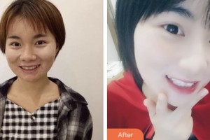 荊門(mén)小白兔口腔醫(yī)院陳中浩整形價(jià)格表附牙齒隱形矯正案例展示