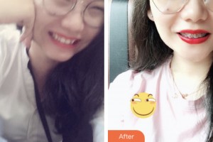 荊門(mén)市口腔醫(yī)院鄒廷前整形價(jià)格表附金屬托槽矯正案例展示