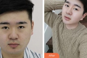 株洲藝佳醫(yī)療美容?？漆t(yī)院李文軍整形價(jià)格表附假體隆鼻案例展示