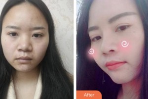 株洲愛(ài)思特醫(yī)療美容醫(yī)院張新成整形價(jià)格表附鼻部綜合案例展示