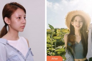 株洲宇芳姬醫(yī)療美容門診部歐陽(yáng)甜整形價(jià)格表附硅膠隆鼻案例展示