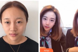 泰州愛爾眼科醫(yī)院王秋燕整形價(jià)格表附眼部綜合案例展示