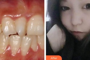 泰州玲瓏口腔門(mén)診部秦琳玲整形價(jià)格表附金屬托槽矯正案例展示