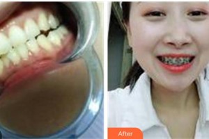 泰州玲瓏口腔門(mén)診部黃榮明整形價(jià)格表附金屬托槽矯正案例展示