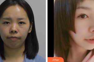 鎮(zhèn)江華美醫(yī)療美容門(mén)診部宋明義整形價(jià)格表附鼻部綜合案例展示