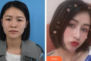湘潭陽光整形美容門診部劉洋整形價(jià)格表附肋軟骨隆鼻案例展示