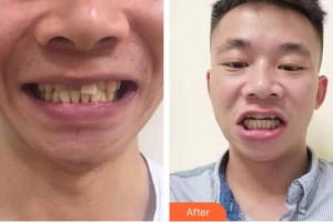 永州牙博士口腔醫(yī)院唐林平整形價格表附牙齒隱形矯正案例展示