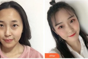 順德愛(ài)爾眼科醫(yī)院劉巧萍整形價(jià)格表附眼部綜合案例展示