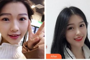 順德愛(ài)爾眼科醫(yī)院林為華整形價(jià)格表附眼部綜合案例展示