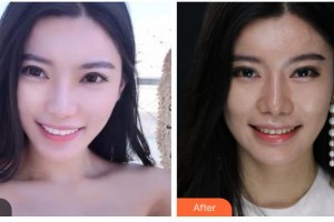 榆林婦產(chǎn)?？漆t(yī)院韓式整形美容中心劉軼整形價(jià)格表附美白貼片案例展示