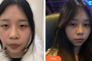 慶陽華美醫(yī)療美容診所劉懷樸整形價(jià)格表附切開雙眼皮案例展示