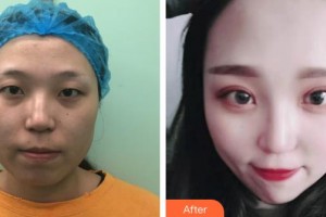 慶陽美立方醫(yī)學(xué)美容診所李智勇整形價(jià)格表附眼部綜合案例展示