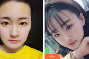 銀川維多利亞醫(yī)療美容醫(yī)院佟新玲整形價(jià)格表附埋線(xiàn)提升案例展示